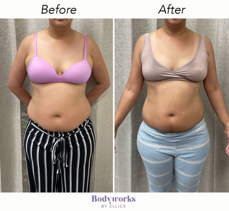 Before & After Body Sculpting Bodyworks by Ellice